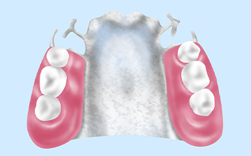 金属床義歯（チタン合金・コバルトクロム合金など）