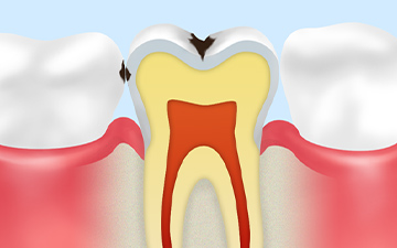 C1：エナメル質の虫歯