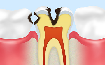 C2：象牙質の虫歯