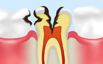 C3：歯の神経にまで達した虫歯