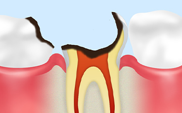 C4：歯根に達した虫歯
