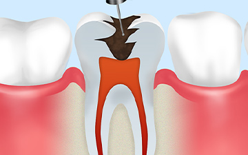 STEP1虫歯部分の除去